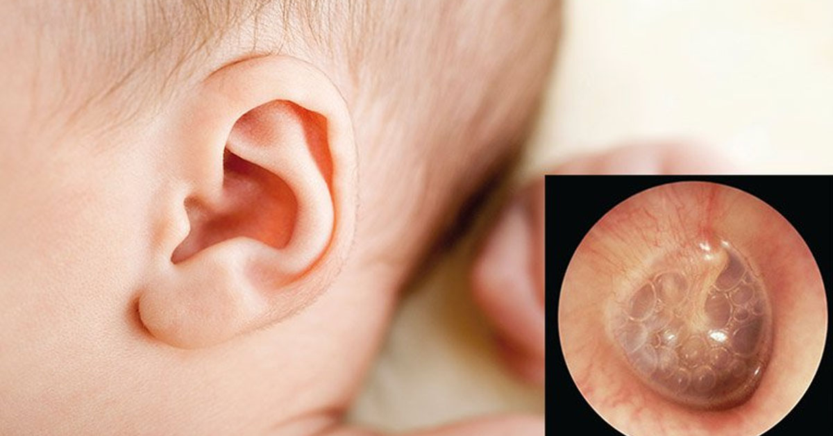 Dấu hiệu, cách chăm sóc và phong bệnh viêm tai giữa ở trẻ nhỏ
